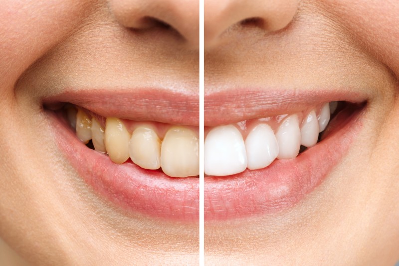 before-after-2