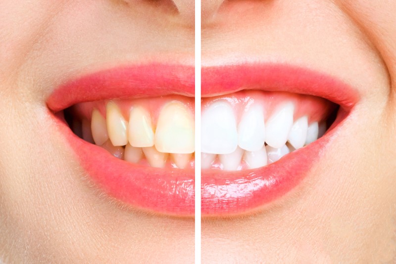 before-after